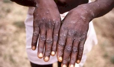 ದೇಶದ ಮೊದಲ ಮಂಕಿಪಾಕ್ಸ್ ಸೋಂಕಿತ ವ್ಯಕ್ತಿ ಗುಣಮುಖ