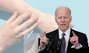 ಹೆಚ್ಚಿದ ಮಂಕಿಪಾಕ್ಸ್‌ ಆತಂಕ; ಆರೋಗ್ಯ ತುರ್ತು ಪರಿಸ್ಥಿತಿ ಘೋಷಿಸಿದ ಅಮೆರಿಕ