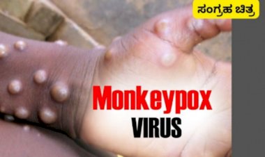 ಮಂಗಳೂರು: ಉಡುಪಿ ಮೂಲದ ವ್ಯಕ್ತಿಗೆ ಮಂಕಿಫಾಕ್ಸ್ ದೃಢ- ಮಂಗಳೂರಿನಲ್ಲಿ ಚಿಕಿತ್ಸೆ